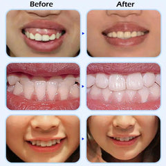 4Pcs Silicone Anti-Snoring Dental Guards Set