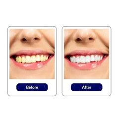 5D Teeth Whitening Strips | 7/14 Pairs Stain Remover Gel