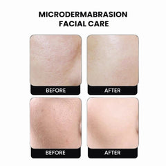 3 in 1 Microdermabrasion Vacuum & Spray Device - facial care