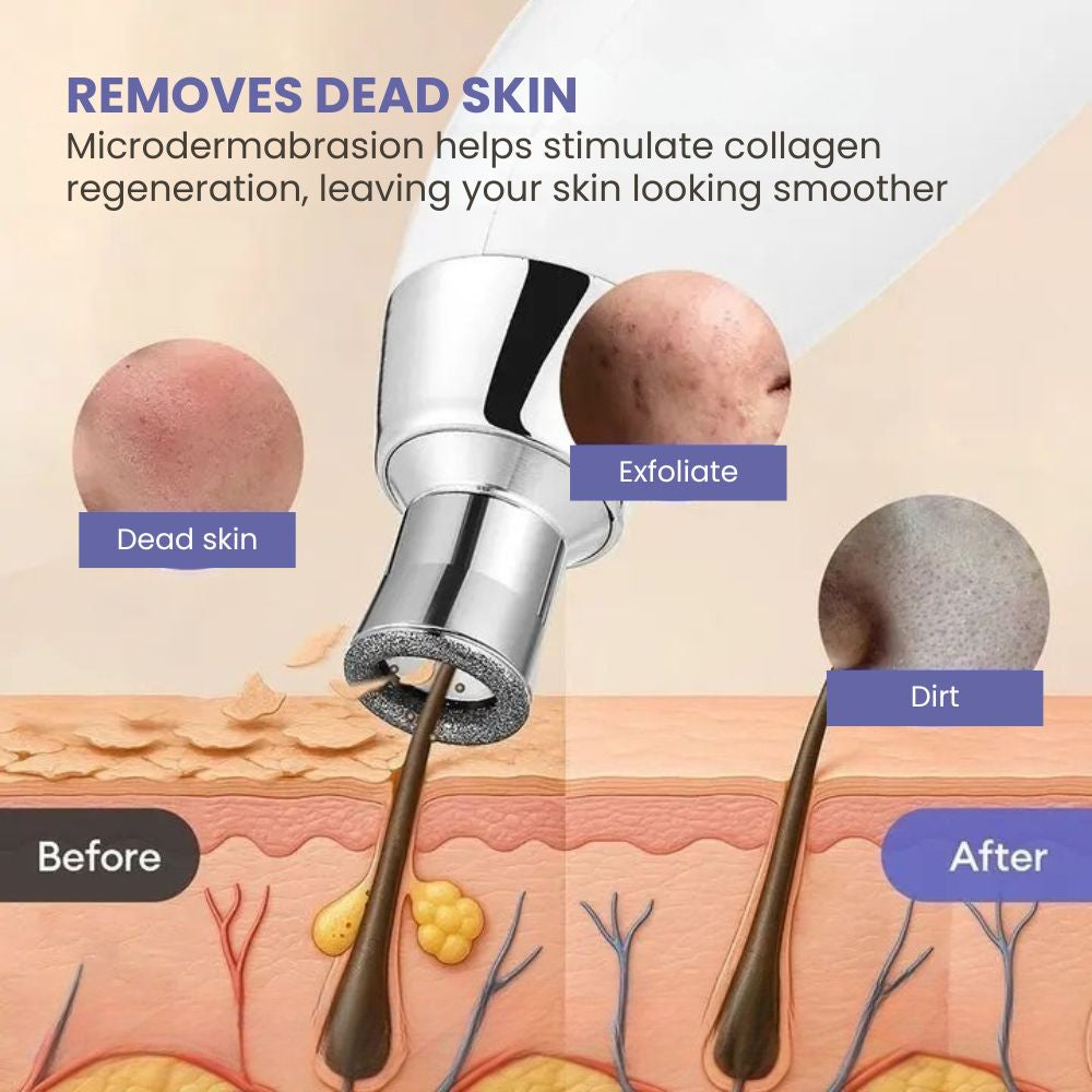 Diamond Microdermabrasion Facial Peeling Device 60KPa - removes dead skin