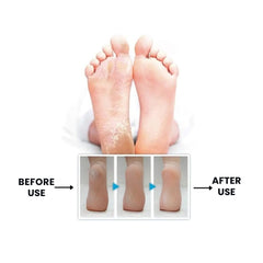 Foot Razor Callus Remover with 10 Replacement Blades
