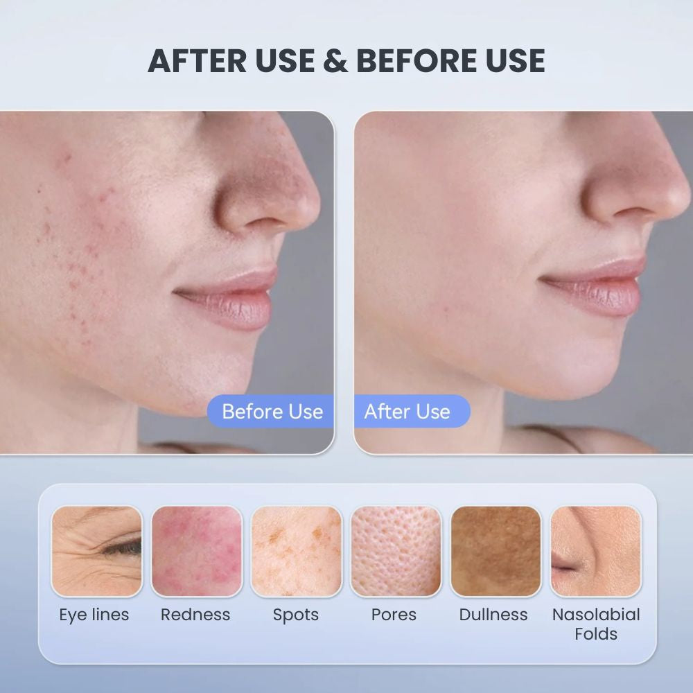 LED Photon Therapy Face Mask for Skin Rejuvenation - before after