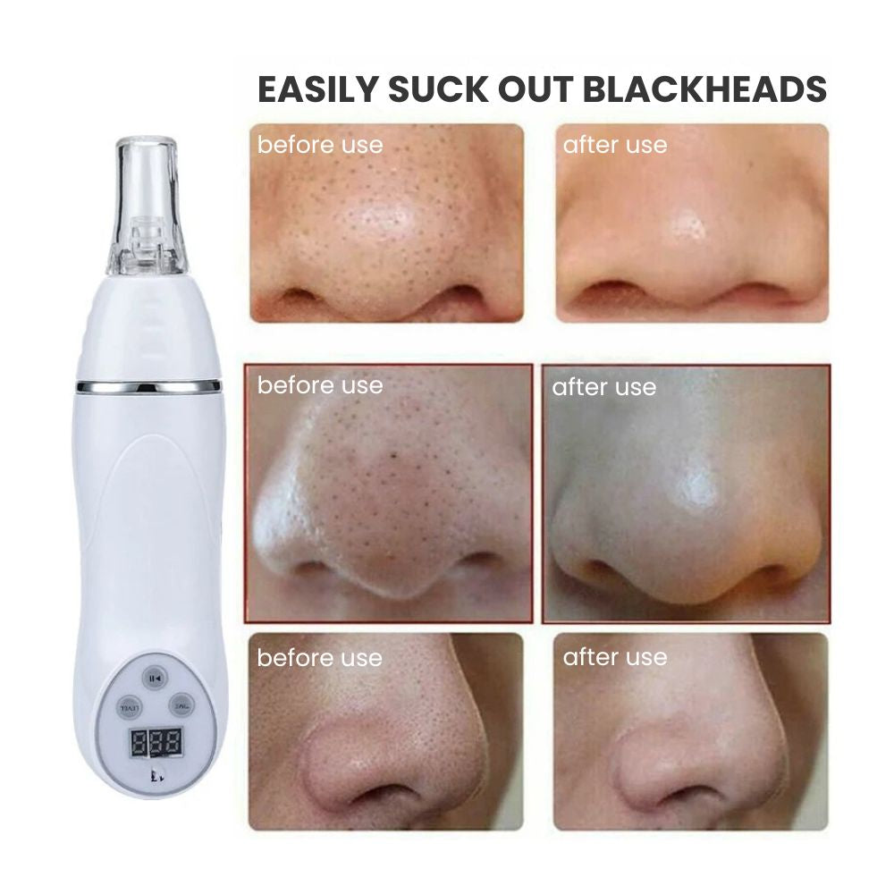 Microdermabrasion Diamond Peeling Vacuum Facial Device - Remove blackheads