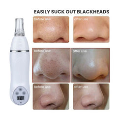 Microdermabrasion Diamond Peeling Vacuum Facial Device - Remove blackheads