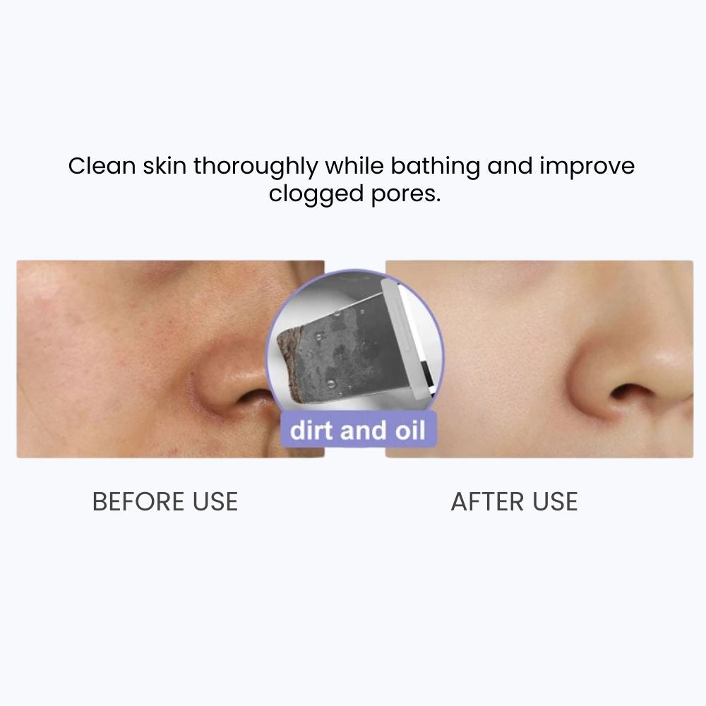 Ultrasonic Skin Scrubber — 24KHz Deep Pore Cleanser - clean skin